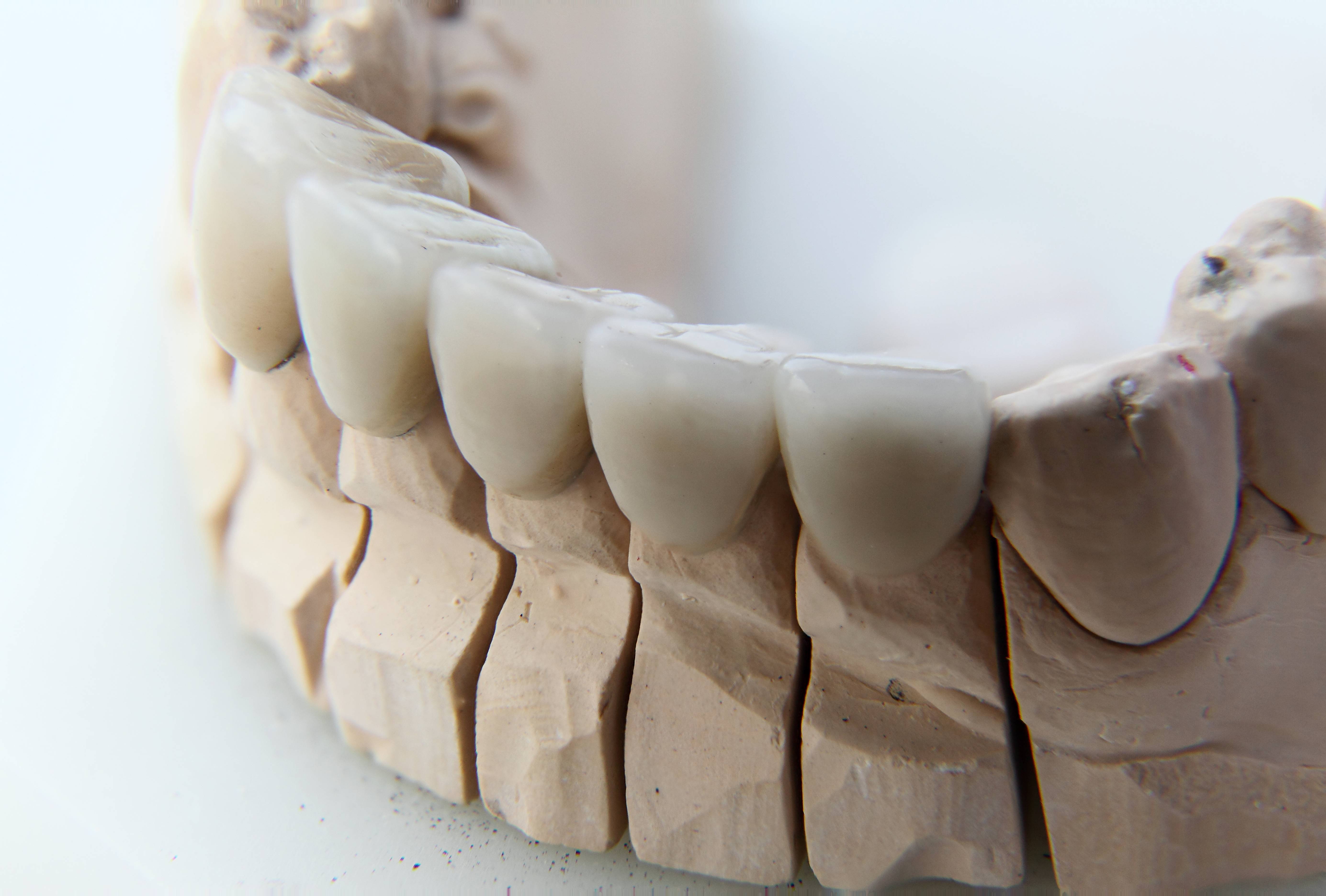 What are Veneers?