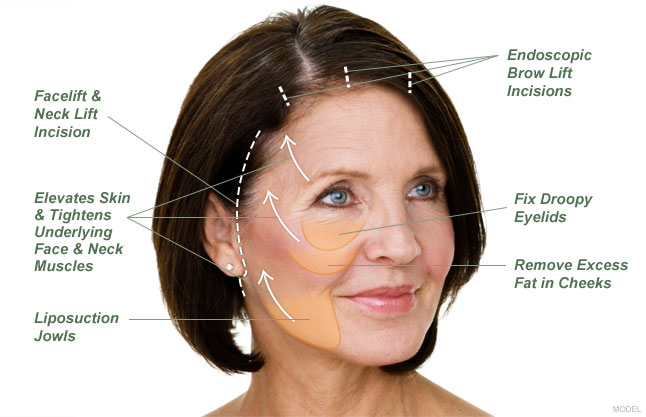 Facelift Procedure Description