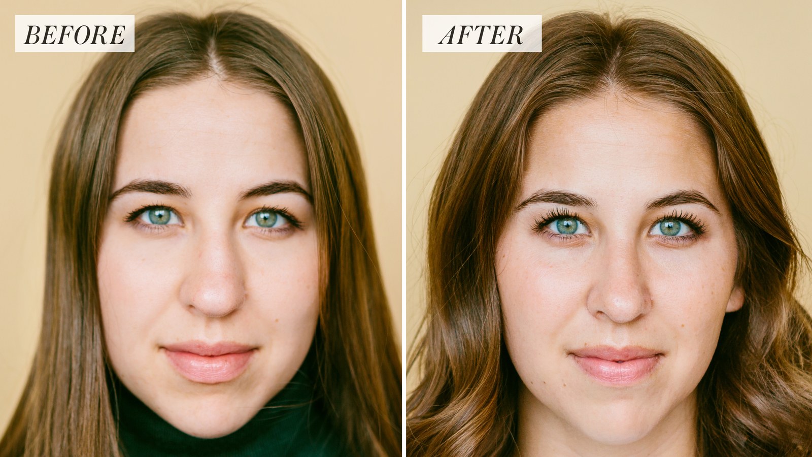 Rhinoplasty Procedure Description