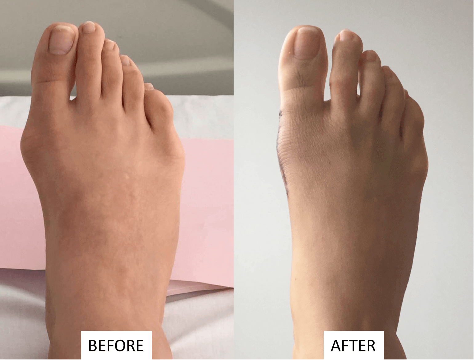 Bunion Surgery Procedure Description