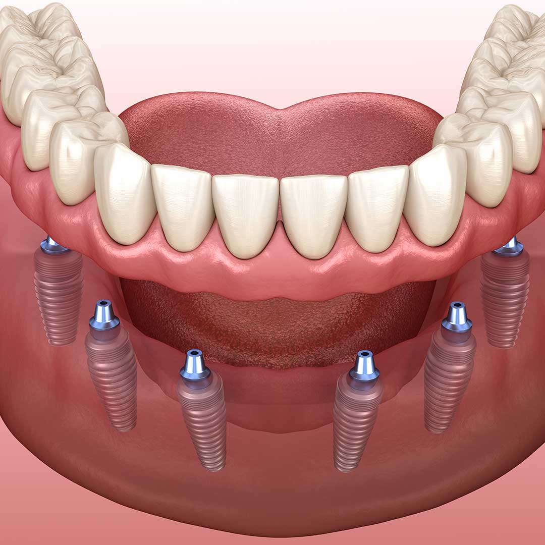 All-on-6 Procedure Description