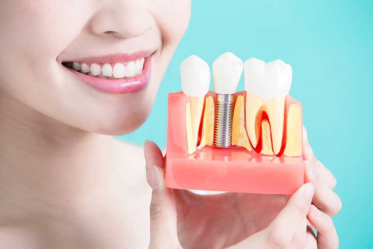 Dental Implant FAQ