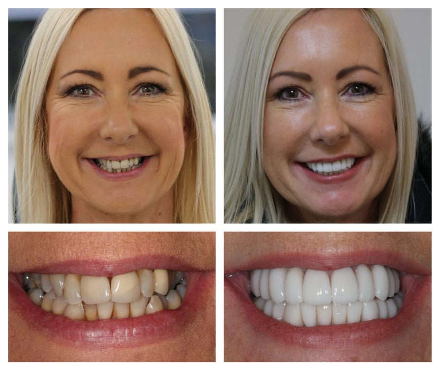 The Benefits of Veneers that will Improve my Smile