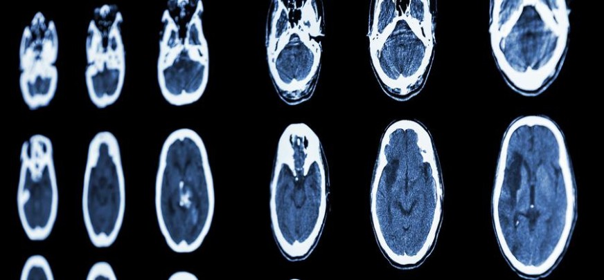Various diagrams looking for signs of Brain Haemorrhage